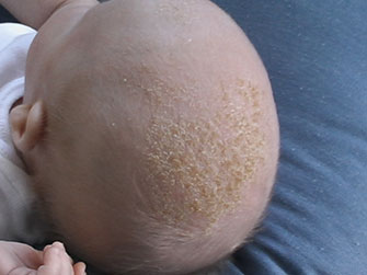 Behandling når baby har arp i hovedbunden, panden eller øjenbryn
